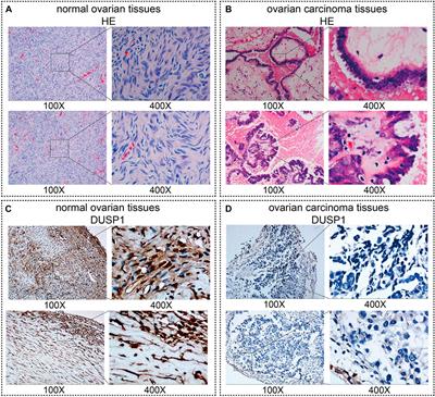 Downregulated Dual-Specificity Protein Phosphatase 1 in Ovarian Carcinoma: A Comprehensive Study With Multiple Methods